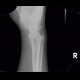 Os epipyramis, accessory bone: X-ray - Plain radiograph